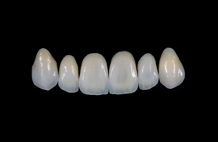 Ceramic Inlay and Onlay